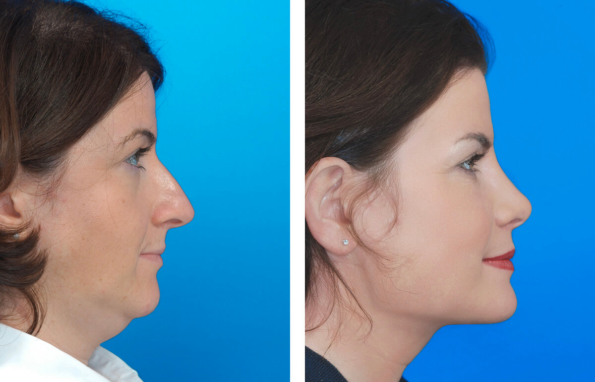 Das Facelift zur Verjüngung fortschreitender Hautalterung des Gesichts